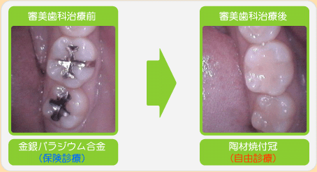 審美歯科治療前→審美歯科治療後